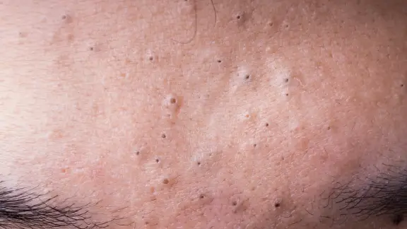 Black heads on male forehead