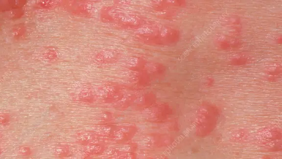 red papules