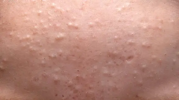 whiteheads from acne